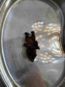 Foreign object removed during surgery